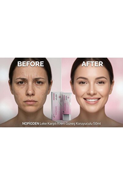denge ilaç Nopigden Anti-Blemish Sunscreen Face Cream 50 ml Daily Skin Care M...