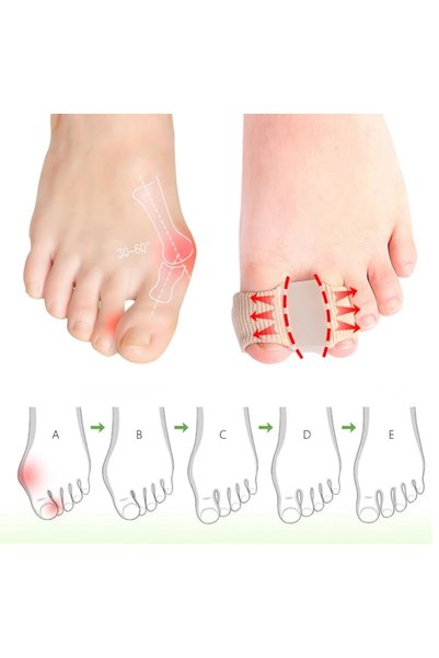 DONGGUAN Toe Separator – Big Toe Corrector |   Toe Nail Separator to Help Keep Toenails Apart |   Silicone Toe Separator for Overlapping Toes |   1 Pair |   Size: L
