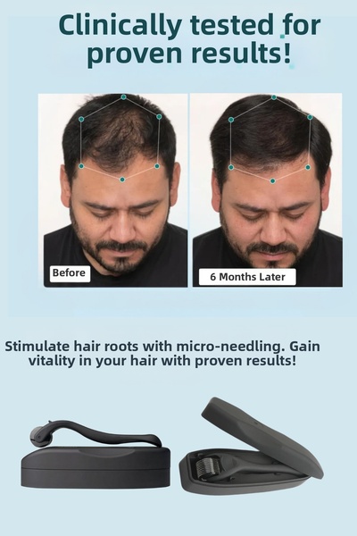 Dermotik 540 Needles Titanium Tip 0.75 mm Sparse Hair and Facial Care Dermaroller Skin Massage Tool