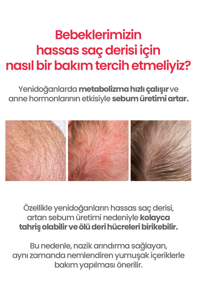 Atopalm Bebeklere&Yenidoğanlara Özel Konak Karşıtı Saç Derisi Losyonu Newborn Scalp Lotion