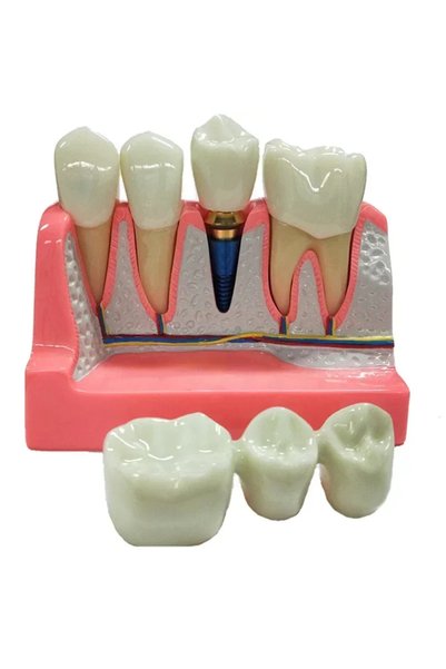 Choice new crown bridge Dental Implant Teach Crown Bridge Removable Model Por...