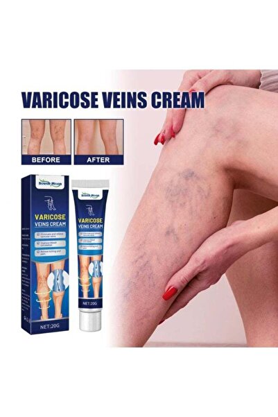South Moon Varicose Veins Cream – Advanced Care for Beautiful-Looking Legs