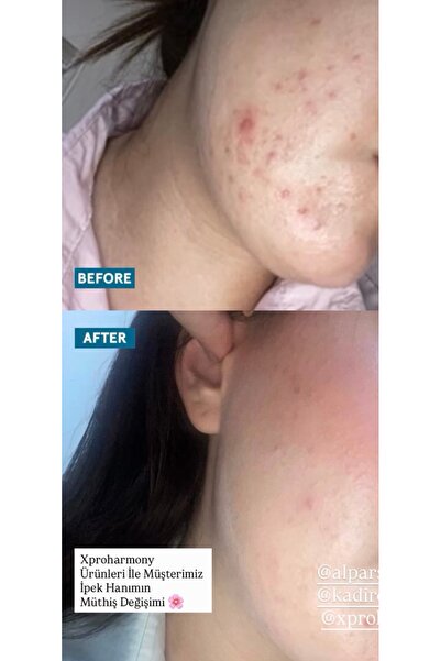 PROHARMONY Aha Bha Skin Renewal Serum 30ml