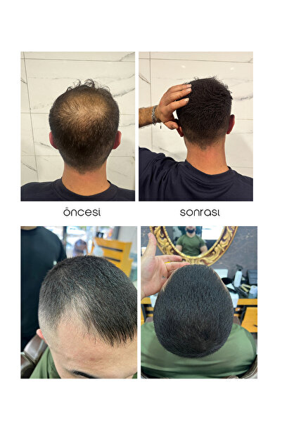 Slaj Seyrek Saç Kapatıcı Kalıcı Losyon – Anında Hacimli Doğal Görünüm - 50ml X 2 ADET