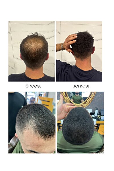 Slaj Seyrek Saç Kapatıcı Kalıcı Losyon - Saç Kapatıcı Dolgunlaştırıcı Sıvı Krem – Anında Hacimli Doğal Görünüm 50ml x 2 ADET
