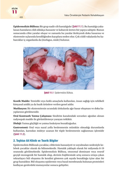 Hipokrat Kitabevi Vaka Örnekleriyle Pediatrik Rehabilitasyon