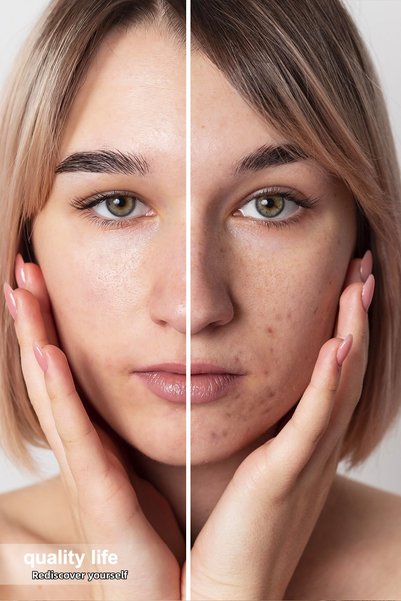 Quality Life سيروم مضاد لحب الشباب والبثور 4 أكتيف - يزيل آثار التجفيف والبثور السوداء وآثار العيوب