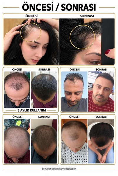 Izzo Hair Serum |   Intensive Care Serum That Supports Hair Formation for Sparse and Thinning Hair Areas |   Serum 5X50 ml Dermaroller