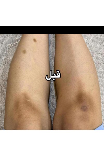 MA BEAUTY Vitamin C Exfoliating Scrub for Knees and Elbows