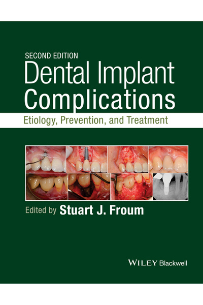 Wiley-Blackwell Complicații ale implanturilor dentare: Etiologie, Prevenție ș...