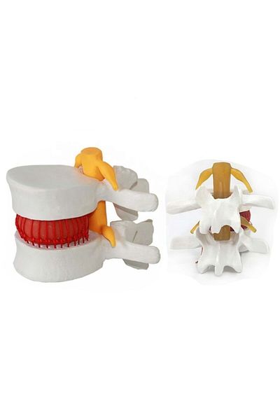 FİZYOMALZEME Disc Herniation (Hernia) Model Model 16