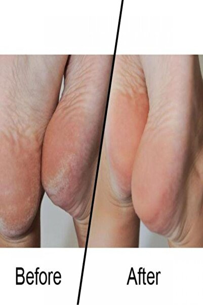 Micropedi Ayak Bakım Cihazı Seti Nasır Törpüsü 5'li Manikür Pedikür Seti