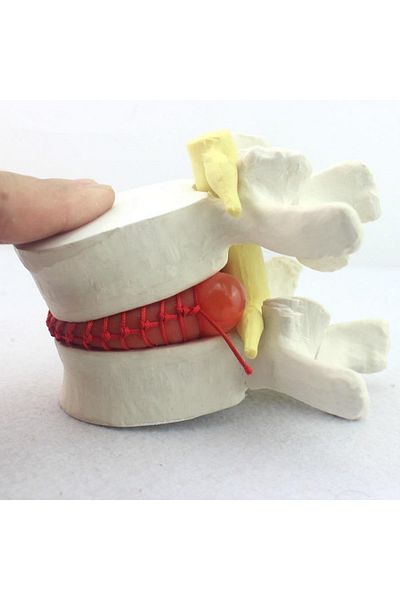 MAXİ Hernia Model 2 - Disc Herniation