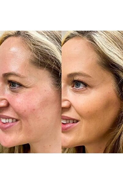 AKOLİFE Yüz Germe Bant Açık Kahve Uzun Süreli Kullanım Anında Botoks Etkisi K...