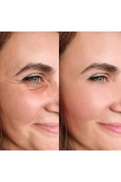 AKOLİFE Facelift Buckle -botox Clasp- Face Lift Tape (BLACK) - Yüz Germe Kaş ...