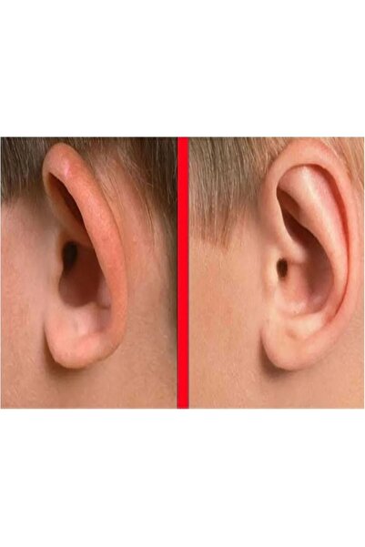 inobag Şeffaf Çift Taraflı Kepçe Kulak Düzeltme Bandı, Kulak Bandı, Kepçekula...