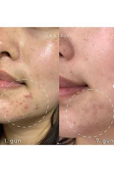 AXIS-Y 15ml Regional Acne and Blemish Serum - Spot the Difference Treatment