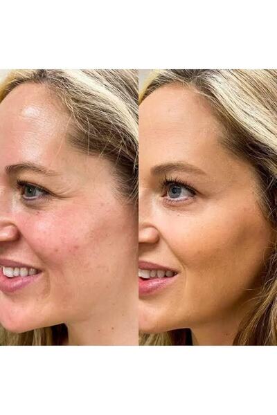 AKOLİFE Kahve Renk Yüz Germe Botoks Tokası Facelift Kaş Kaldırma Göz Germe Yüz Gerdirme