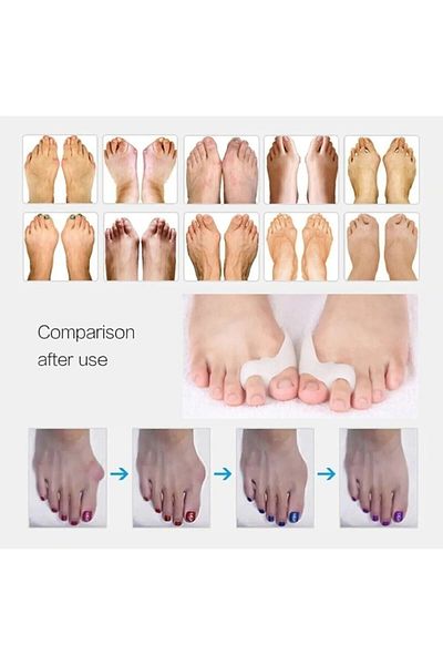 Devi Metatarsal Pad that Fits the Middle Finger