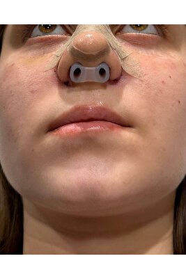Burun Deligi Sekillendirici 2-8 No-nostril Retainer ürün fotoğrafı