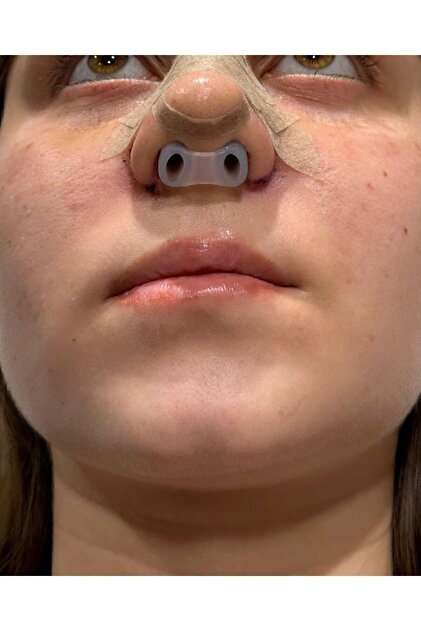 Burun Deligi Sekillendirici 2-8 No-nostril Retainer