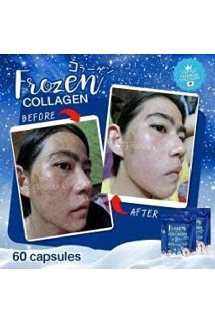 frozen glutathione review Detailed review about collagen must watch till end❤️ , #thaistore,  #thaiproducts #whiteningserum #hyaluronicacid #vitamincserum #antiwrinkle  #antiaging #collagen #collagensupplement #whiteningproducts main image 1