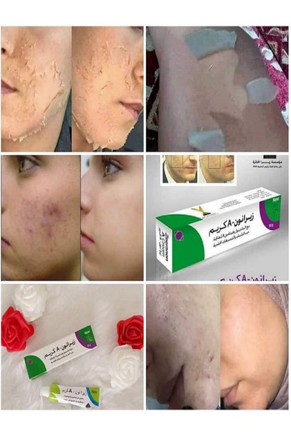 Zeeranon A Krem Melazma Kremi Çil Kremi Kremi Akne Ve Cilt Kusurları Onarıcı