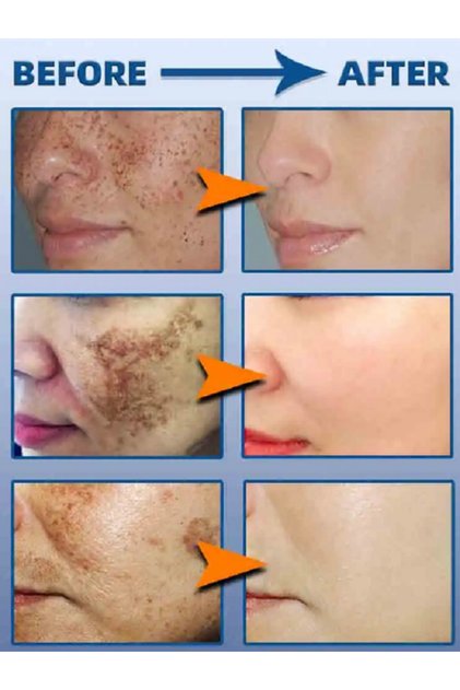 Çil - Güneş Yanığı - Kloazma - Radyasyon Noktaları - - Cyasma Giderici Krem
