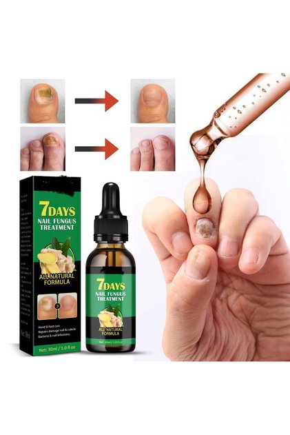 Traitement Antifongique Pour Ongles 7 Days - Formule Naturelle Au Gingembre, 30ml, Neuf, Fabriqué En Chine
