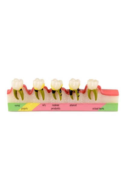 Periodontal Hastalık Sınıflandırma Modeli - Diş Maketi - 15 x 3 x 5cm