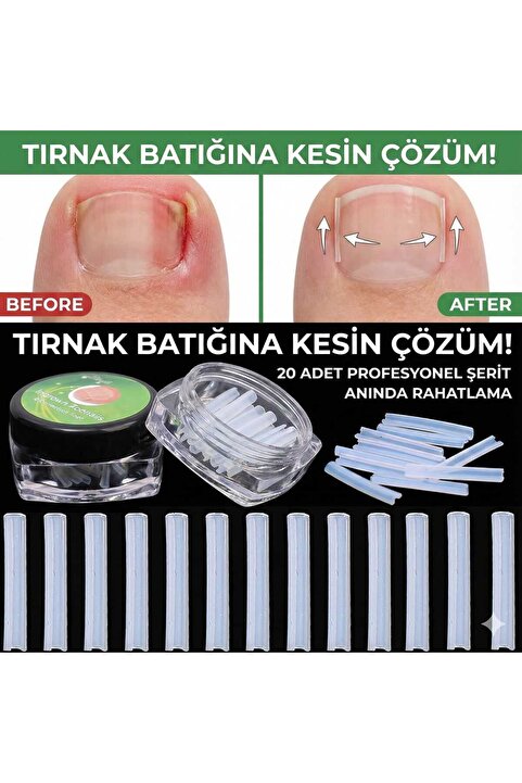 LOVYCO Batık Tırnak Düzeltici Plastik Şeritler 20 Adet