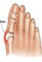 1 Pair of Foot Health Care - Thumb Bone Protrusion, Bunion Corrector Hallux Vallgus - 3