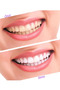 Blue Light Technology Teeth Whitener Set - 4