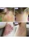Natural Psoriasis Cream - 8