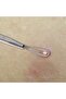 Double Loop End Blackhead Remover - 2