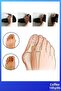 Hallux Valgus - Finger Bone Protrusion Corrector for Night Splint and Bunion Treatment - 3