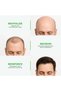Neo Hair Lotion 120ml | Advanced Hair Regrowth Treatment Lotion For Hair Fall, Bald Spots & Thinning - 4