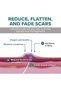 Epi-Derm C-Strips Silicone Scar Sheets 1.4x6in, 1 Pack, Clear - 5