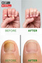 Nail Repair Serum Hand and Foot Fungus, Deodorizing - 2