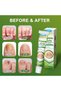 New Nail Fungal Feet Cream Foot Toe Nail Fungus Gel - 3