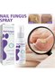 Jaysuing Nail Fungus Spray, Natural anti-fungal Nail Treatment 100ml Fungal Nail Treatment - 2