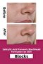 50ML Cream Moisturizing and Skin Renewing Anti-Blemish - 3