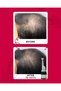 Anti-Hair Loss Treatment Lotion, 12 Vitals - Boost Hair Growth, Strengthens - 5