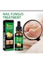 Nail Fungus Treatment Serum 7 Days Care Formula for Toenail & Fingernail Repair - 6