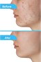 Acne Pore Anti-Blackhead Cream Moisturizing Anti-Blemish Cream for Oily and Combination Skin - 2