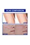 Ultra Advanced Silicone Scar Gel 15g – Clear Scar Treatment Formula - 7