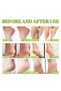 42% Urea Foot Cream with 2% Salicylic Acid for Dry, Cracked Heels- 100g - 4