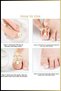 Ingrown Nail Correction Tool |   Ingrown Nail Remover Apparatus |   Toenail Ingrown Nail Tool - 3