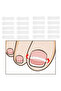 10Pcs Ingrown Toe Nail Treatment Ingrown Toenail Correction Tool Elastic Patch Sticker Straighten... - 2