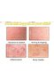 Cystic Acne Removal Cream – Antibacterial Soothing Moisturizer, Support for Youthful Clear Skin - 3